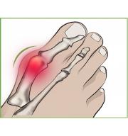 Gelenkschutz bei Schiefstand des Großzehs (Hallux valgus) mit Gelkissen