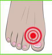 Fingerseparator Schutz für Ballenzehen (Hallux Valgus) 1 Paar